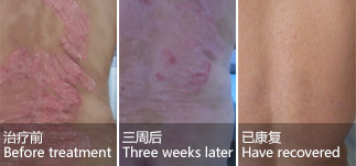 Female, back psoriasis for 5 years