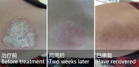 Male, hand psoriasis for 2 years