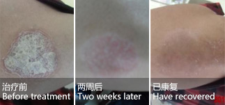 Male, hand psoriasis for 2 years