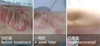 Female, arm psoriasis for 3 years