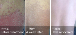 Male, back psoriasis for 2 years