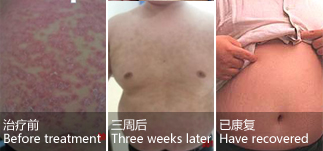 Male, belly psoriasis for one year